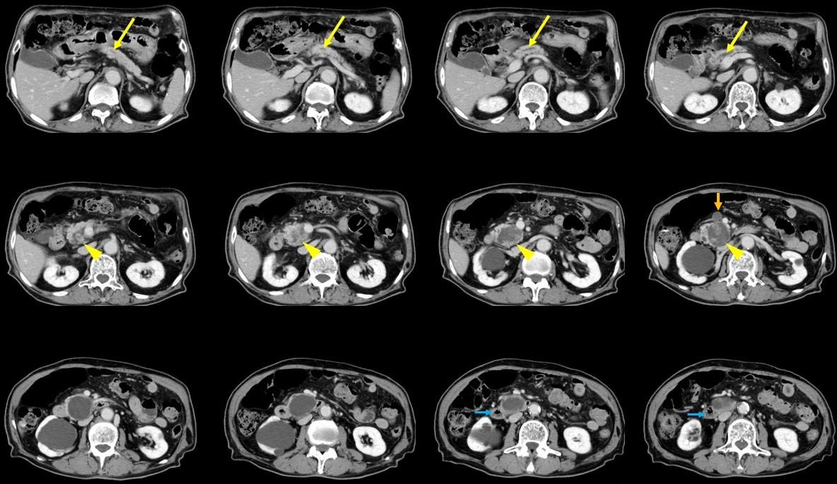 膵臓の嚢胞性病変 Dr. Tomの徒然日記